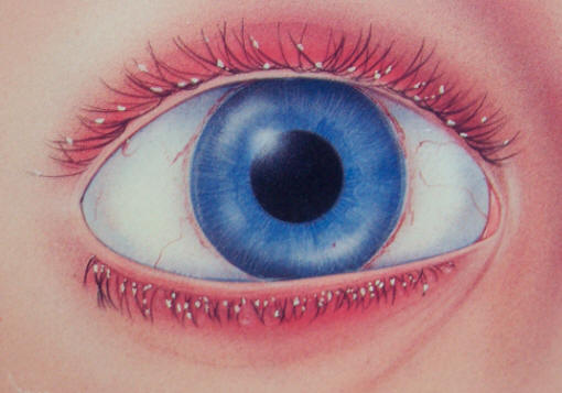 Blepharitis — eyelid margin inflammation