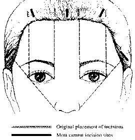 Endoscopic brow lift — step 1