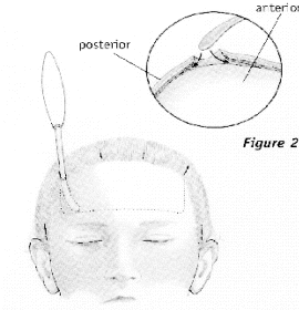 Endoscopic brow lift — step 3