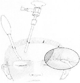Endoscopic brow lift — step 6