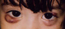 Chalazion in a child