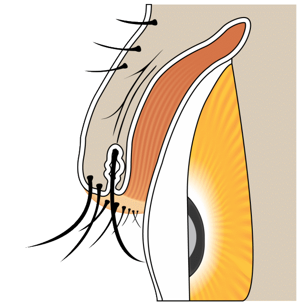 Distichiasis — second row of eyelashes
