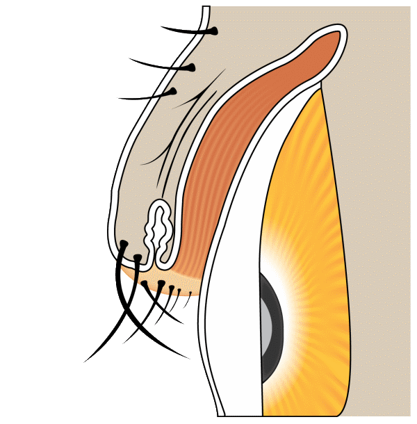Trichiasis — lashes pointing toward the eye