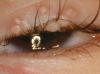 Molluscum contagiosum &mdash; periocular distribution